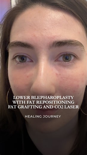 Christopher Zoumalan, MD FACS on Instagram: "Lower Eyelid Blepharoplasty with Fat Repositioning, Fat Grafting, and Carbon Dioxide Laser Resurfacing Healing timeline shown: before surgery, 6 days post-op, and 3 weeks post-op At 6 days post-op, swelling and bruising are still present, especially in the lower eyelids and midface. This is a normal part of the early healing phase after fat repositioning, fat grafting, and laser resurfacing. By 3 weeks, you can already see significant improvement in u