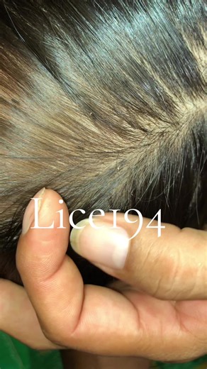 Effective Lice Removal Techniques for Home Use