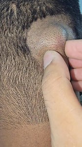 1M views · 2.2K reactions | Scalp cyst | Dr Khaled's Tumour Helpline | Facebook