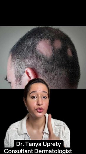 #fyp #alopeciaareata #alopecia #thyroidproblems | alopecia