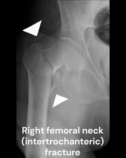 Right femoral neck (intertrochanteric) fracture