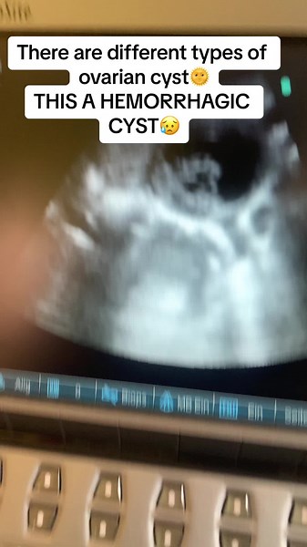 A Hemorrhagic ovarian cyst could be caused due to several factors 😥#Hemorrhagiccyst#ovariancyst #fertilityjourney #radiographer