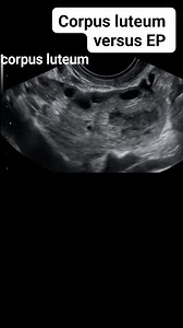 Corpus luteum cyst versus extra ovarian ectopic pregnancy on ultrasound #radiology #medical #LoveUltrasound #radiologist #ultrasound #fblifestyle | Radiology Interesting Cases