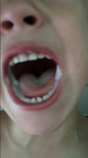 Intermittent Explosive Disorder