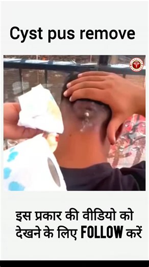 Azhar Alvi on Instagram: "Cyst pus remove #doctor #hospital #icu #ajmedicoz #lab"