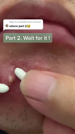 Advanced Pimple Popping Techniques Part 2