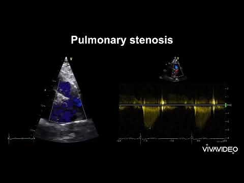 Pulmonary Stenosis Echo