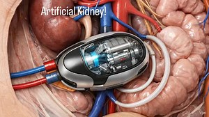 The implantable bioartificial kidney is a coffee-cup-sized medical device currently in development to replace dialysis and traditional transplants. Current Status (2025) * Availability: It is not yet available for patients. Researchers estimate clinical trials may begin in the next 2–3 years, with a goal of commercial availability by 2030. * Latest Progress: Teams at UCSF and Vanderbilt have successfully tested small-scale prototypes in animals, demonstrating that the device can filter blood and