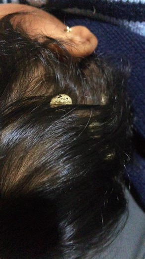 Effective Tick Removal Techniques You Need to Know