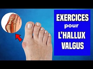 HALLUX VALGUS: PHYSIOTHERAPY TREATMENT AND EXERCISES
