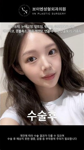 성형 전후 실화… 자연스러운 눈매 + 무보형물 코성형으로 완성된 변화👃✨