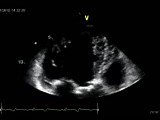 Non-Compaction Cardiomyopathy • Video • MEDtube.net