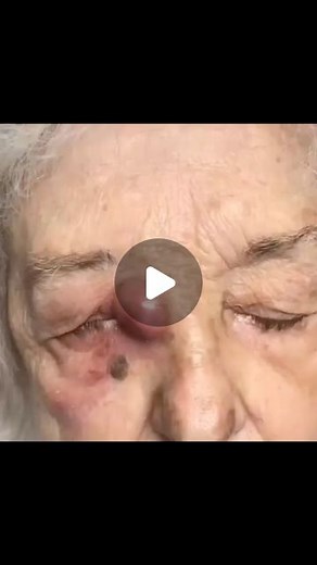 Medschoolposts | Video showing a severe case of dacryocystytis- tear duct infection! Dacryocystitis is characterized as an inflammatory state of the... | Instagram