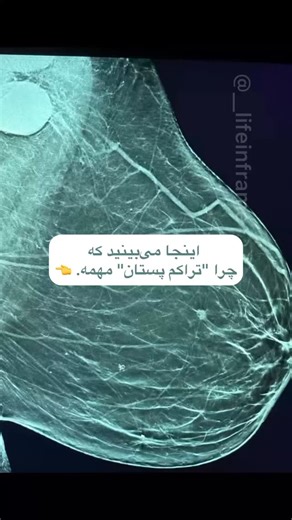 lifeinframe on Instagram‎: "تراکم پستان (Breast Density) تراکم پستان یعنی نسبت بین بافت غده‌ای و بافت چربی در پستان که در ماموگرافی مشخص می‌شود. 🔹 طبق استاندارد BI-RADS، چهار نوع تراکم پستان داریم: A – تقریباً تماماً چربی (پستان کم‌تراکم 🧈) B – با پراکندگی بافت غده‌ای (تراکم خفیف 🌸) C – تراکم ناهمگن (تراکم متوسط تا بالا 🌷) D – بسیار متراکم (تراکم بالا 🌹) ✨ پستان‌های متراکم باعث می‌شن: •تشخیص توده‌ها در ماموگرافی سخت‌تر بشه (چون هر دو سفید دیده می‌شن ⚪️). •احتمال سرطان پستان کمی بیشتر باشه �