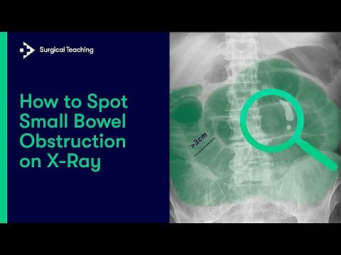 Small Bowel Obstruction | How do we Diagnose it on Abdominal X-Ray?