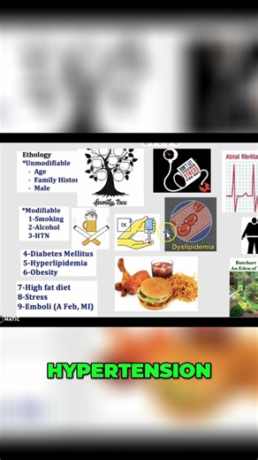 Stroke Risk: Understanding Carotid Artery Disease & Causes #shorts