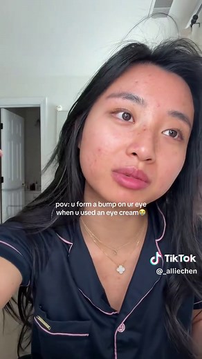 How to Effectively Remove Milia at Home