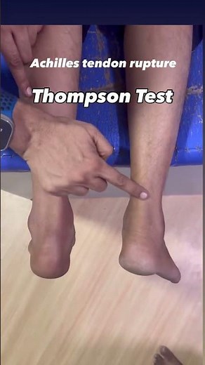 Thomson Test for Achilles Tendon Rupture | Quick & Easy Clinical Ortho Test 🦶