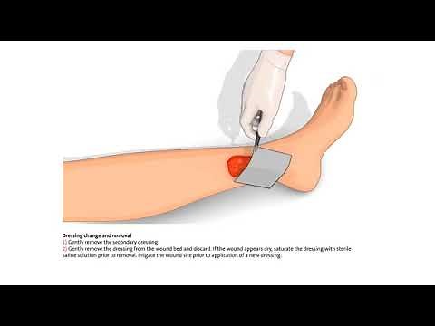 How to use the Silvercel Non-Adherent Hydro Alginate Antimicrobial Dressing