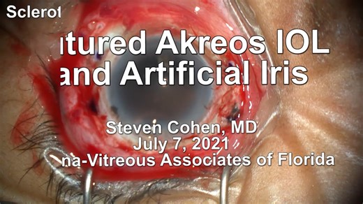 Sutured Artificial Iris and Intraocular Lens