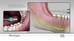 inferior-alveolar-mandibular-nerve-block-injection-wand