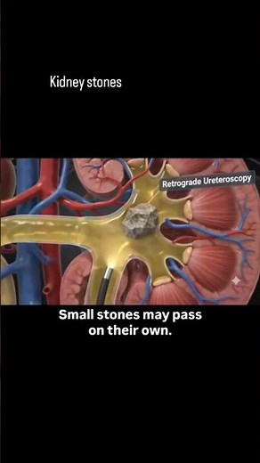 🚨 Kidney Stones: Warning Signs, Symptoms & Treatment Explained #kidneystones