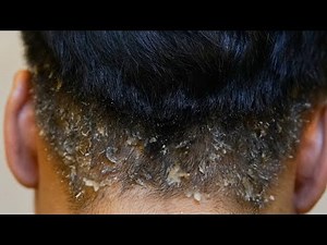 Extreme Dandruff Scratching And Removal (Big Flakes)