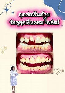 Review of front tooth filling with composite filling material.