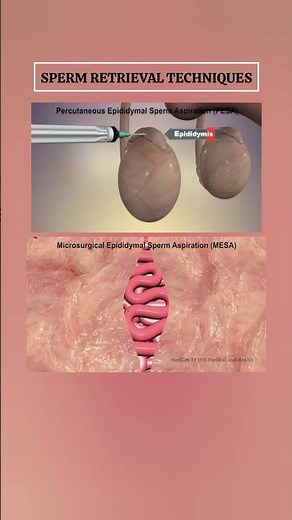 Sperm Retrieval Techniques : Microsurgical Epididymal Sperm Aspiration
