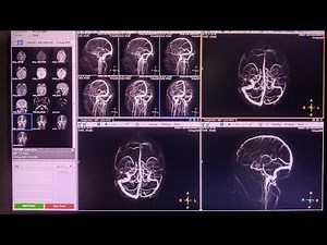 MRI Brain Venography on Philips System