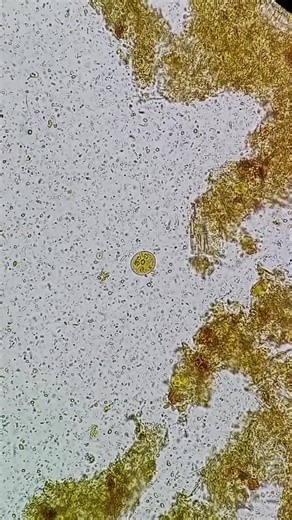 Stool sample##mlt#LabTechnician#LabTechLife#MedicalLaboratory#ClinicalLab#MedicalLabTechnology#LabLife#MedTechStudent#FutureMedTech#LabScience#STEMCareers#HealthScience#ScienceExplained#MedEd#MicroscopeMagic#LabWork#ScienceTok#LabTok#PathologyLab#BloodAnalysis#Hematology#MicrobiologyLab#FYP#Fo#TikTokScience#StudyTom#DayInTheLife#POVLabTech#BehindTheScenes #MedicalLaboratory #BloodTest#MedicalLabTech#Microscopy#MedicalLab#ClinicalLab#Microscopy#MedicalLab#ClinicalLab#LabTech#MedLabScience#LabLife