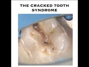 CRACK TOOTH SYNDROME - Diagnosis & Management