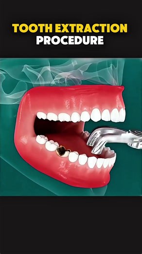 Tooth Extraction (3D Animations) #3danimation