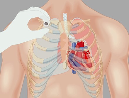 Pneumothorax and Needle Thoracostomy Procedure