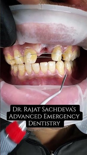 Tooth Mobility After Injury | Splinting Ka Sahi Time