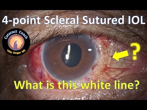 Four-Point Scleral Fixation of an IOL using Gore-Tex - Cataract Coach