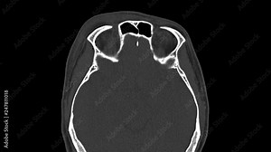 CT X-ray Scan on Human Brain fracture orbit.