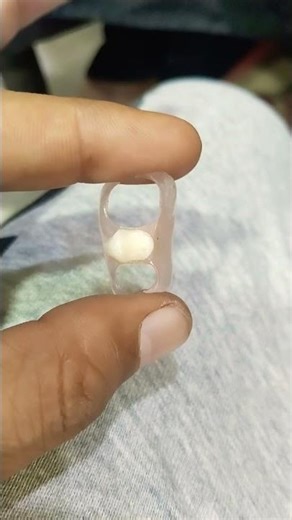 Single Unit Flexible Removable Partial Denture By Haider 😁😁😁#rpddentalprocedure#viralvideo