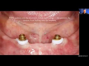 Paul’s Case: Chairside Locator Fitting & Milling-in Paste for Perfect Denture Bite – Study Club Live