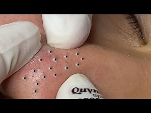 Big Cystic Acne Blackheads Extraction Blackheads & Milia, Whiteheads Removal Pimple Popping # 1744