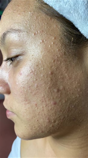 Guía sobre Comedones Cerrados y Limpiezas Faciales