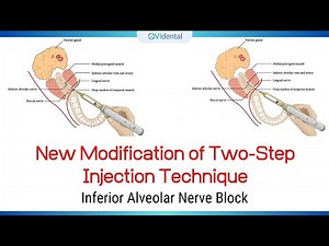 IANB: New Modification of Two Step Injection Technique