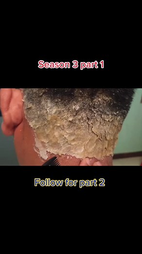 Season 3 part 1 #psoriasisremoval #plaque #scalpcleanse #OneSliceChallenge #StudentSectionSauce #scalpremedy #plaquepsoriasis #hair #part1