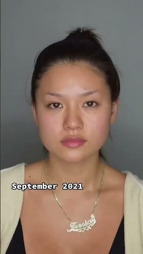 Buccal Fat Removal BEFORE & AFTER #beforeandafter #plasticsurgery #glowup #buccalfatremoval