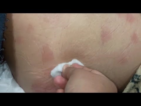 Female hip injection video