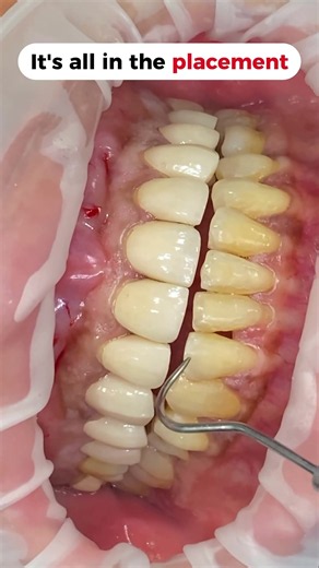 Porcelain Veneers: Transform Your Smile Naturally | Smile Makeover 🦷✨