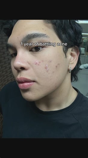 nate on Instagram: "see below ⬇️ for treatments i did to solve acne: 1. Derma consult with @irenegaile - was prescribed isotretinoin for a year 2. Derma V Laser at @dermhq_ - best for reddish marks which I got when active acne subsided 3. Microneedling treatments with @whenapino at @pinobeautylounge - smoothen overall skin texture, tighten and refine skin"