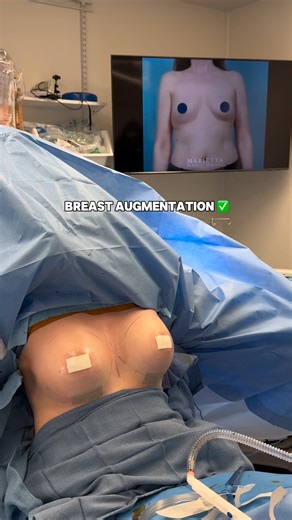 Marietta Plastic Surgery on Instagram: "Her goal: subtle, natural-looking fullness that complements her body. Her result: exactly that. 😉🍒 Breast augmentation by Dr. Biswas @dr.biswasaesthetics with natural, frame-flattering volume! Book your consultation. 📱 Marietta: 770.800.5264 📱 Woodstock: 678.821.5778 🌐 mariettaplasticsurgery.com #mariettaga #atlantaga #atlantaplasticsurgery #breastaugmentation #breastimplants #motivaimplants #mentorimplants"