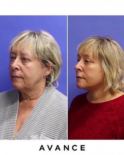 Mini Facelift Before & After Photos Reno NV | Tahoe Mini Facelift | Avance Plastic Surgery Institute