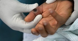 Mpox: What are the symptoms, and how does it spread?